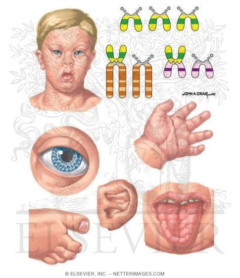 downsyndrome.jpg